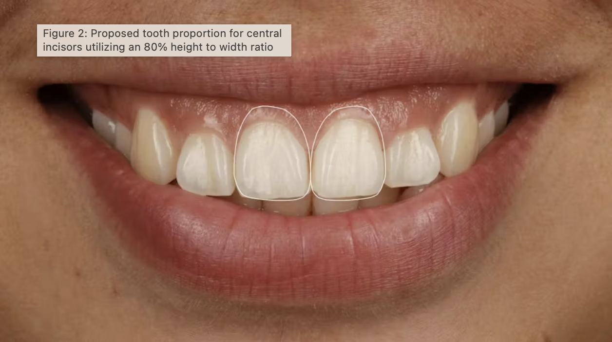 Xác định vị trí đường viền nướu trong thiết kế nụ cười nha khoa